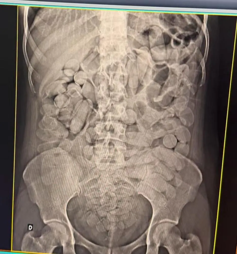 Mulheres são presas com cocaína dentro do estômago em ônibus clandestino em MS